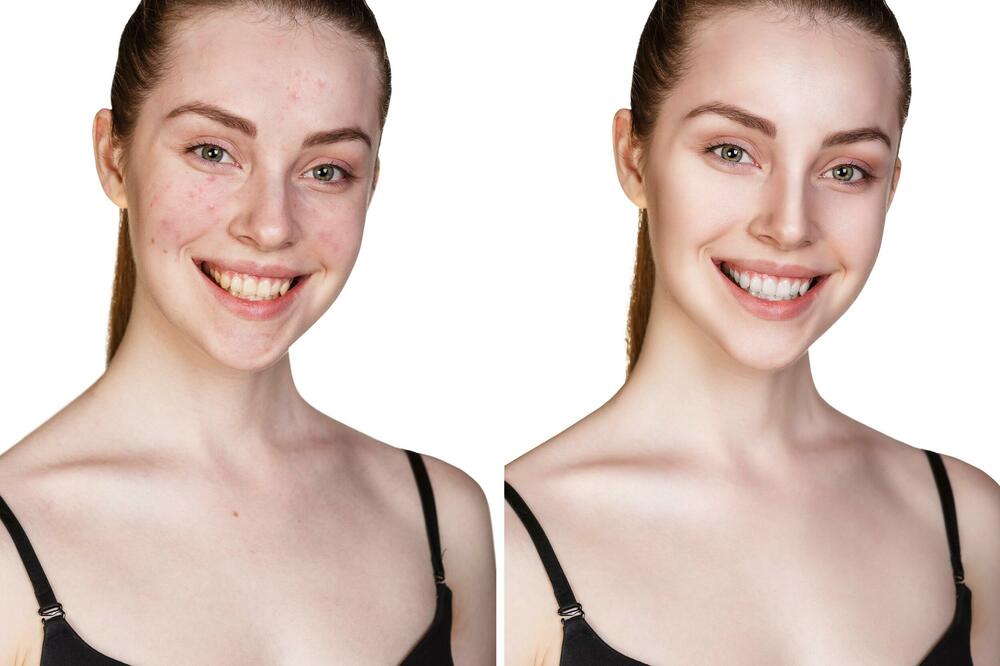 ZA ČISTO I LEPO LICE, BEZ CRVENILA, AKNI I NEPRAVILNOSTI: Beloruski antibakterijski proizvodi po sjajnim cenama!