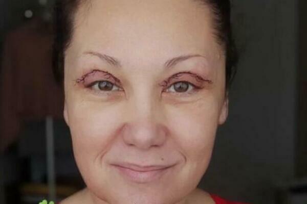 OPERISANA SRPSKA VODITELJKA! Konci svuda oko očiju, otkriven i RAZLOG: Mnoge zgrozio prizor rana! (FOTO)