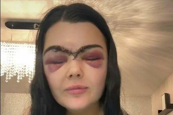 DEVOJKA SE ŠOKIRALA KADA JE POSLE BIZARNE NESREĆE VIDELA LICE U OGLEDALU! Izgledam kao... (VIDEO)