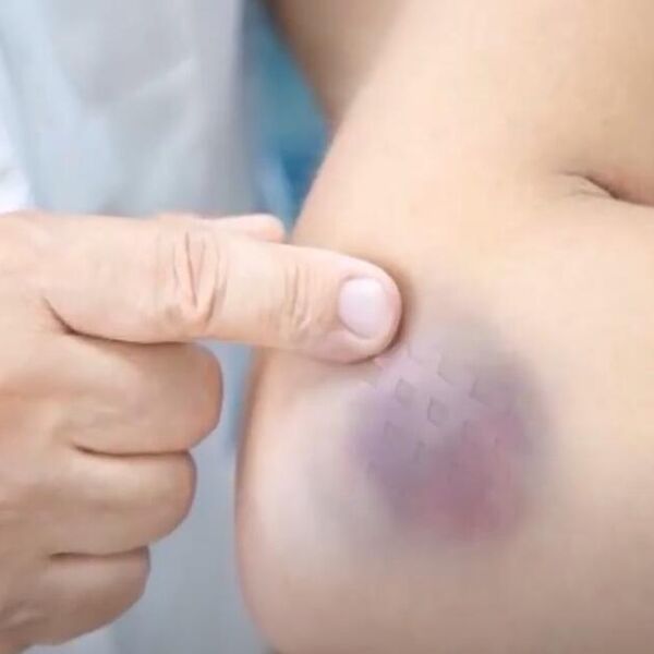 Modrice nakon vađenja krvi: Kada su normalna pojava, a kada znak da hitno morate kod lekara