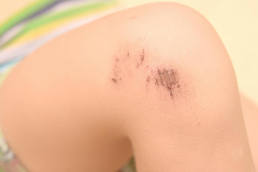 AKO PATITE OD HEMOFILIJE OVO MORATE DA ZNATE: Doktorka Leković objasnila kada su ova KRVARENJA OPASNA PO ŽIVOT