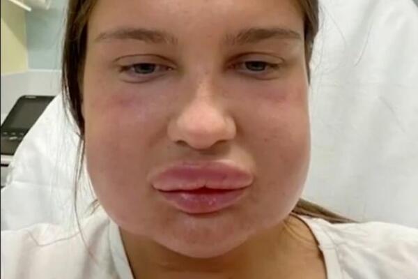 ZBOG MALE KOREKCIJE USANA DOŽIVELA TRAUMU ZA CEO ŽIVOT: Iz kozmetičkog salona završila IZOBLIČENA u bolnici (FOTO)