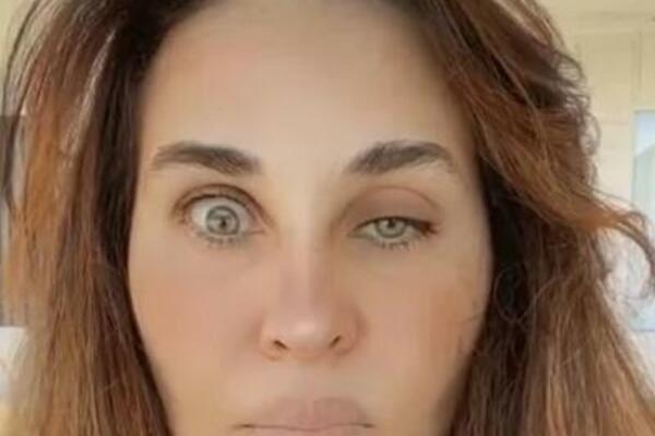 OTIŠLA KOD PLASTIČARA, ON JOJ UBRIZGAO BOTOKS TAMO GDE NE TREBA: Pogledajte kako sada izgleda, ŠOK! (VIDEO)