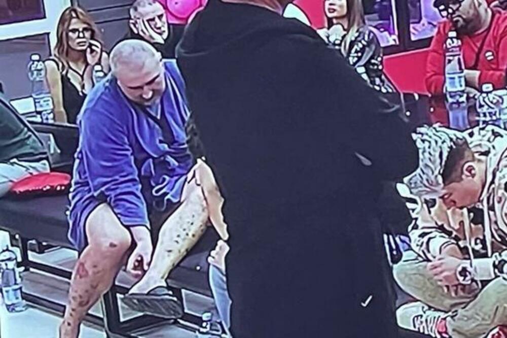 MIKI ĐURIČIĆ JE MAZAO 3 DANA MELEM NA SVOJ ŽIVE RANE: Evo kako danas izgleda!