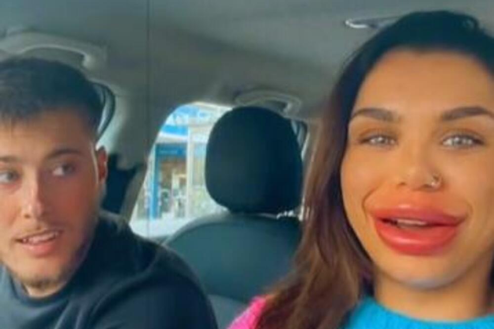 POKUŠAJ PREPRAVKE POŠAO PO ZLU, VELIČINA JE ZABRINJAVAJUĆA: Usne više nisu usne, NE MOŽE DA OBUZDA OTICANJE (VIDEO)