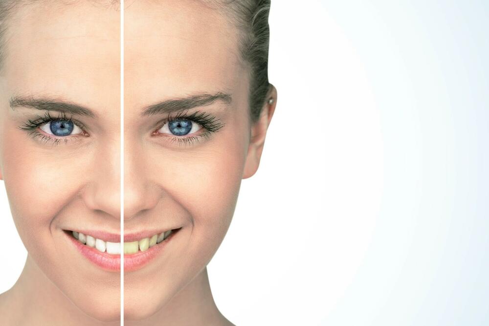 BLISTAV OSMEH BEZ MRLJA: Pogledajte šta može da pomogne kada vam zubi promene boju!