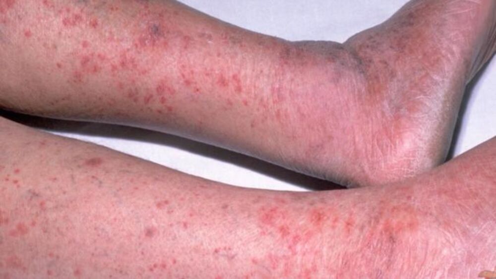 Visok holesterol može da dovede do stanja koje se zove periferna arterijska bolest 