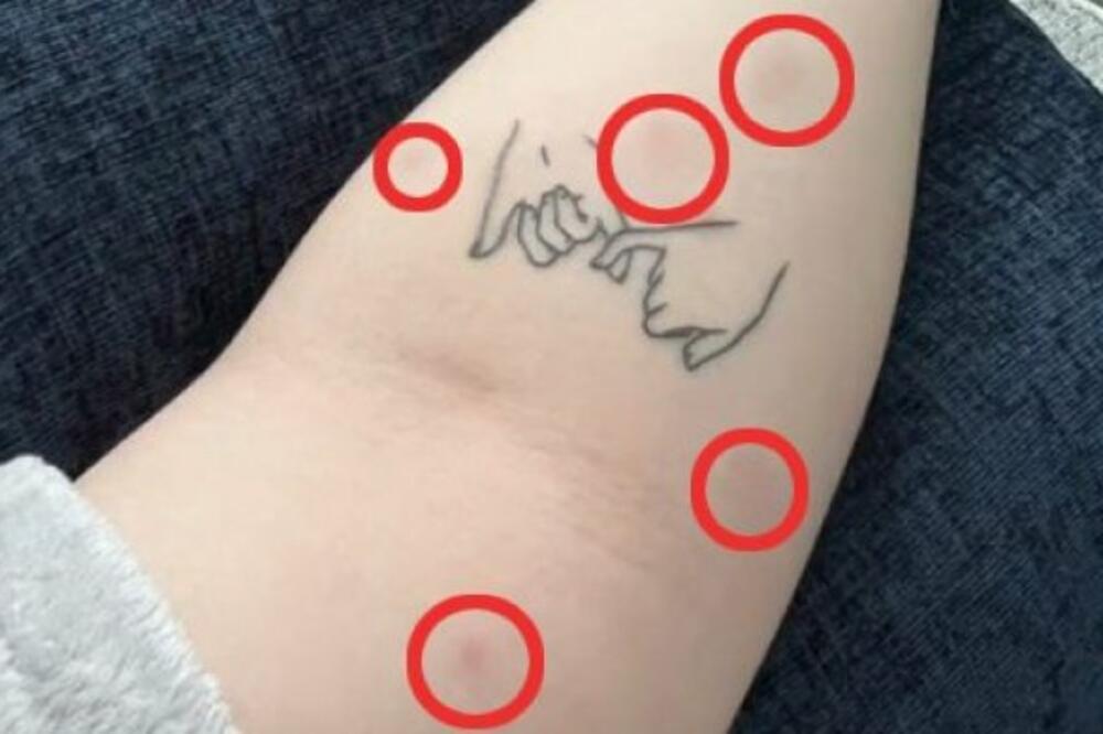 SMRTONOSNA INFEKCIJA POČELA JE SITNIM TAČKAMA! Ličilo je na ujede komaraca, a onda se desilo NAJGORE (VIDEO)