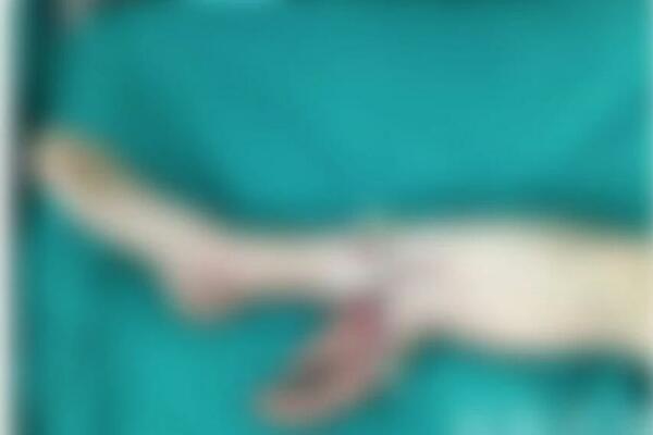 OVO JE NAJBIZARNIJA OPERACIJA U ISTORIJI: Cirkular mu otkinuo ŠAKU, ne verujete gde mu je ZAŠIVENA! (VIDEO)