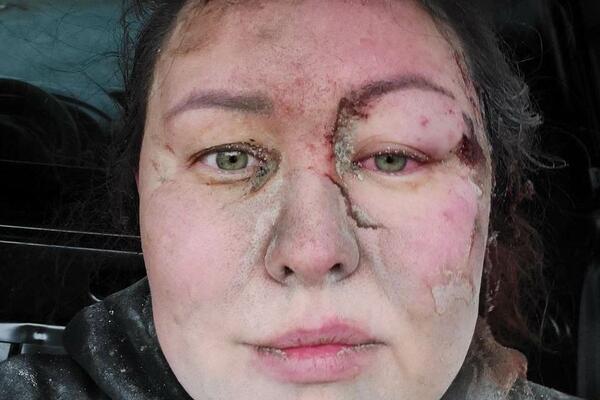 OVA ŽENA JE NA SOPSTVENOJ KOŽI OSETILA RUSKI GNEV! Bavila se SPORTOM, a onda joj je 1 DAN promenio život, TUGA!