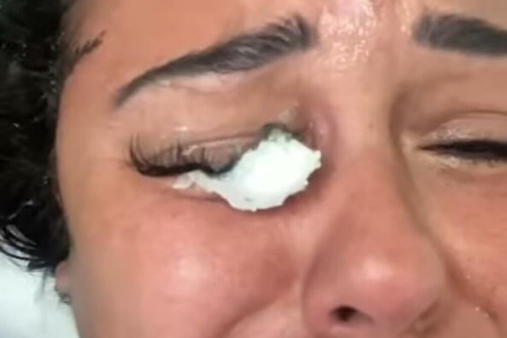 UMALO JE OSLEPELA ZBOG OVOGA ŠTO KORISTI POLA SRPKINJA: Operisali joj OBA oka, izgledala kao da je IZAŠLA IZ POŽARA