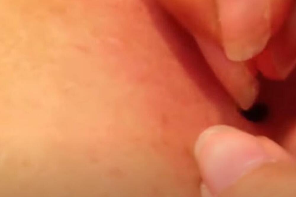 NJEMU JE OVAJ UŽAS BIO 25 GODINA U TELU: Odjeknuo SNIMAK KAKO GA VADE, NE GLEDAJTE NA PRAZAN STOMAK (VIDEO)