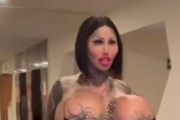 POVEĆALA POLNI ORGAN PA ZAMALO UMRLA: Nećete verovati kako sada izgleda (FOTO)