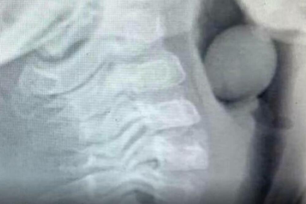 DEČAK (6) UMALO UMRO, JER JE POJEO OVO VOĆE! Rendgenski snimak pokazao šta je PROGUTAO I KRENUO DA SE GUŠI (FOTO)