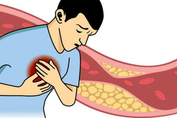 HOLESTEROL MOŽE DA VAS DOKRAJČI ZBOG OVIH NAMIRNICA: Pazite šta JEDETE