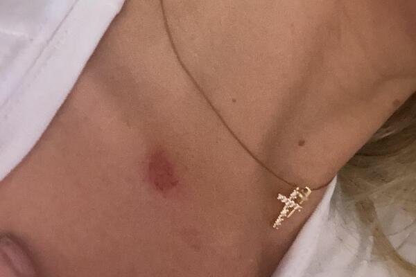 NAŠA PEVAČICA SVA U PODLIVIMA I MODRICAMA: Priložila fotografije kao DOKAZ, svi ZABRINUTI! (FOTO)