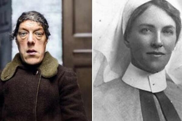 OVA LEPOTICA POSTALA JE NAJRUŽNIJA ŽENA NA SVETU: Zbog ove užane BOLESTI, više nije LJUDSKO BIĆE (FOTO)