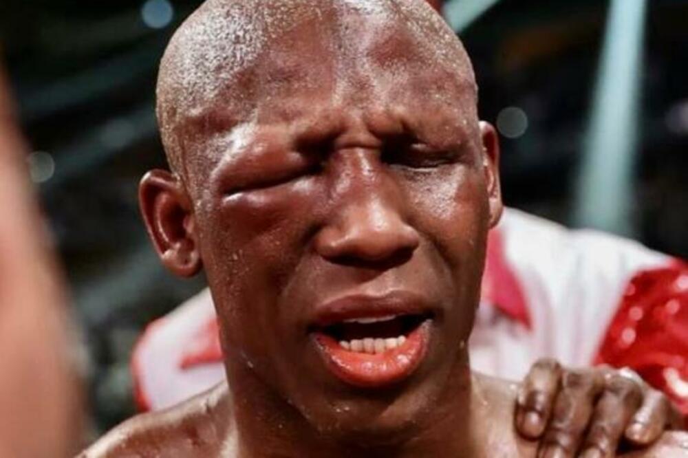 POTRESNE SLIKE: 40 sati nakon meča oko mu je krvarilo! Nedelju dana od borbe - KAO DA JE SADA IZAŠAO IZ RINGA! FOTO