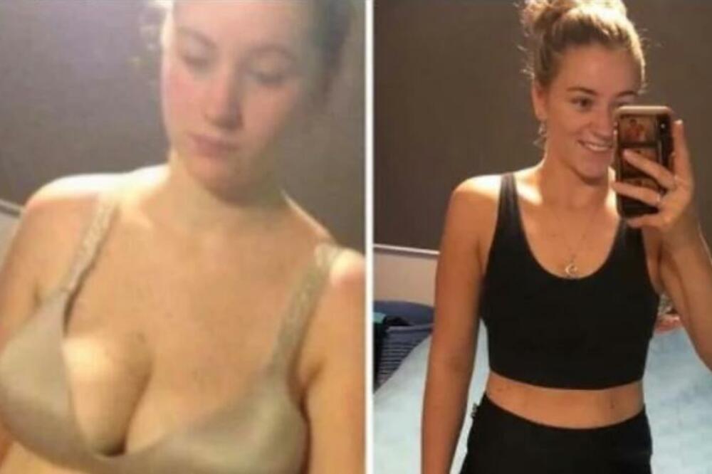 HTELA DA SMRŠA PREKO NOĆI PA BACILA 20.000 EVRA NA OPERACIJU KOJA JE ZAMALO UBILA: Sad izgleda kao KOSTUR (FOTO)