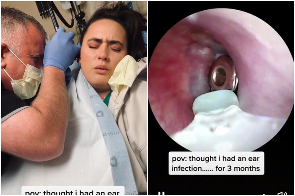 ZGRANUĆE VAS ONO ŠTO SU JOJ PRONAŠLI U UHU: Mesecima mislila da ima UPALU, a kada su joj IZVADILI ... ŠOK VIDEO!