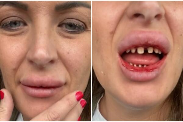JEDNO LOŠE ISKUSTVO IZ TURSKE: Otišla po NOVE zube a evo sa kojim BOLOVIMA se vratila, a tek šta su joj uradili!