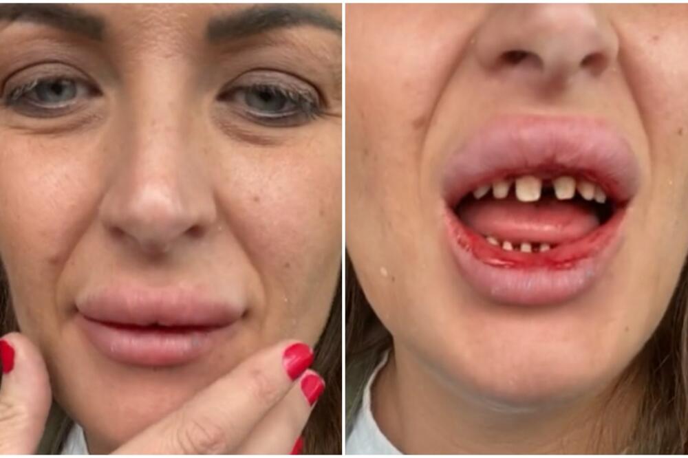 JEDNO LOŠE ISKUSTVO IZ TURSKE: Otišla po NOVE zube a evo sa kojim BOLOVIMA se vratila, a tek šta su joj uradili!