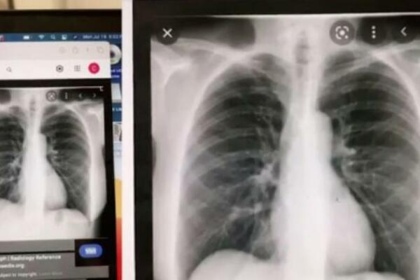 19-GODIŠNJAKINJI SNIMILI PLUĆA, PA UGLEDALI NAJŠOKANTNIJU STVAR IKAD: Lekar je morao to da uradi (FOTO)