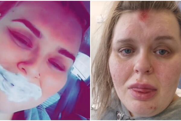 NAKON UBRIZGAVANJA FILERA DOŽIVELA ANAFILAKTIČKI ŠOK: Usne počele da OTIČU, a DISAJNI PUTEVI joj se ZATVORILI!