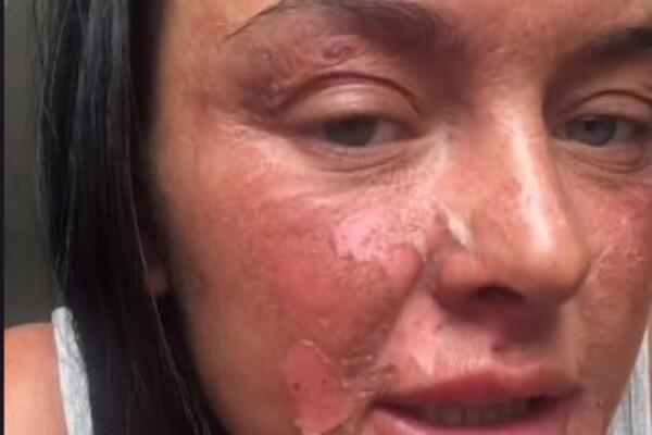 ZBOG 1 GREŠKE U KUHINJI HITNO ZAVRŠILA U BOLNICI: "Bio je to najgori bol u životu" (VIDEO)