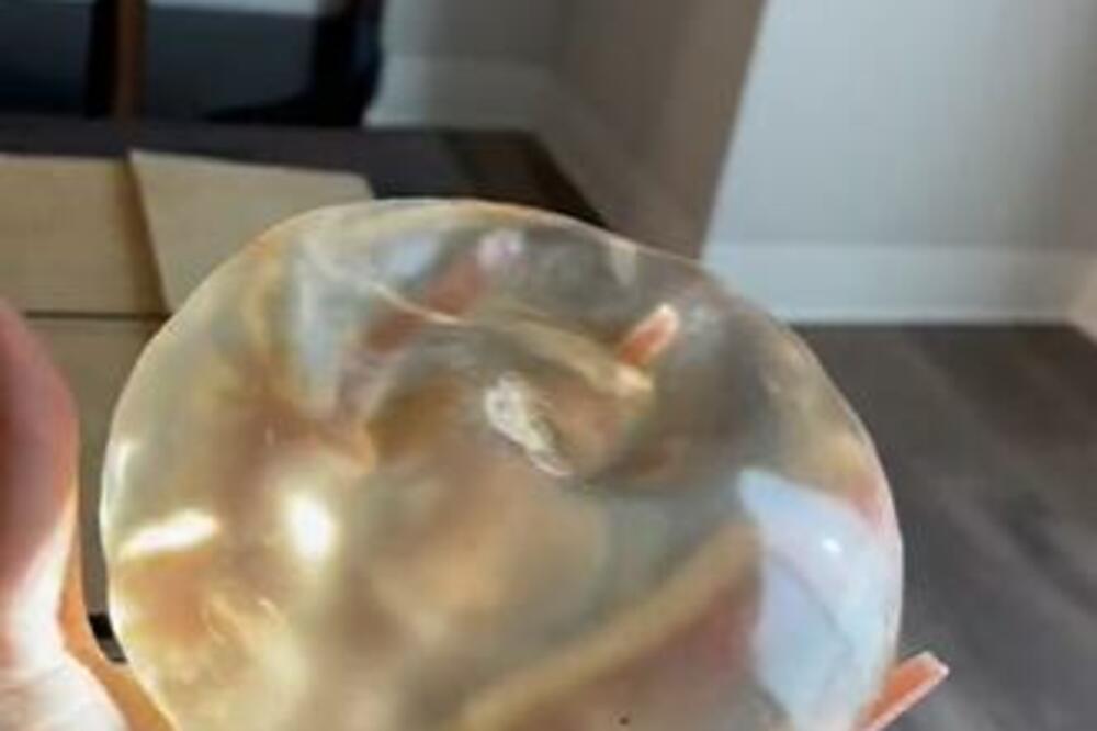 MILENI IZ BEOGRADA PUČE SILIKON NA SRED ULICE: Ima ČETVORO DECE, a umalo ŽIVOT nije IZGUBILA