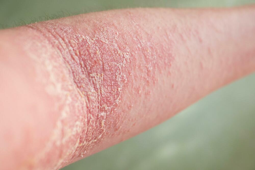 AKO IMATE CRVENILO, SVRAB I SUVU KOŽU ONDA TELO TRAŽI OVAKAV TRETMAN: Evo šta je obavezno uraditi da bi BILO BOLJE