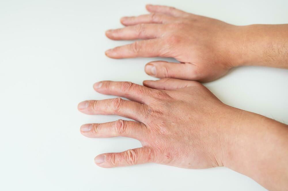 NAJČUVENIJI LEKARI TVRDE DA SU OVO SIMPTOMI BOLESNE JETRE: Za mnoge od njih niste čuli