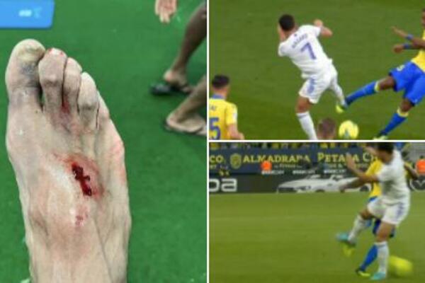 UZNEMIRUJUĆA FOTOGRAFIJA! Posledice fudbala koje ne vidimo odmah: AZAR NE ZNA DA ČUVA NOGE PROTIVNICIMA (FOTO)