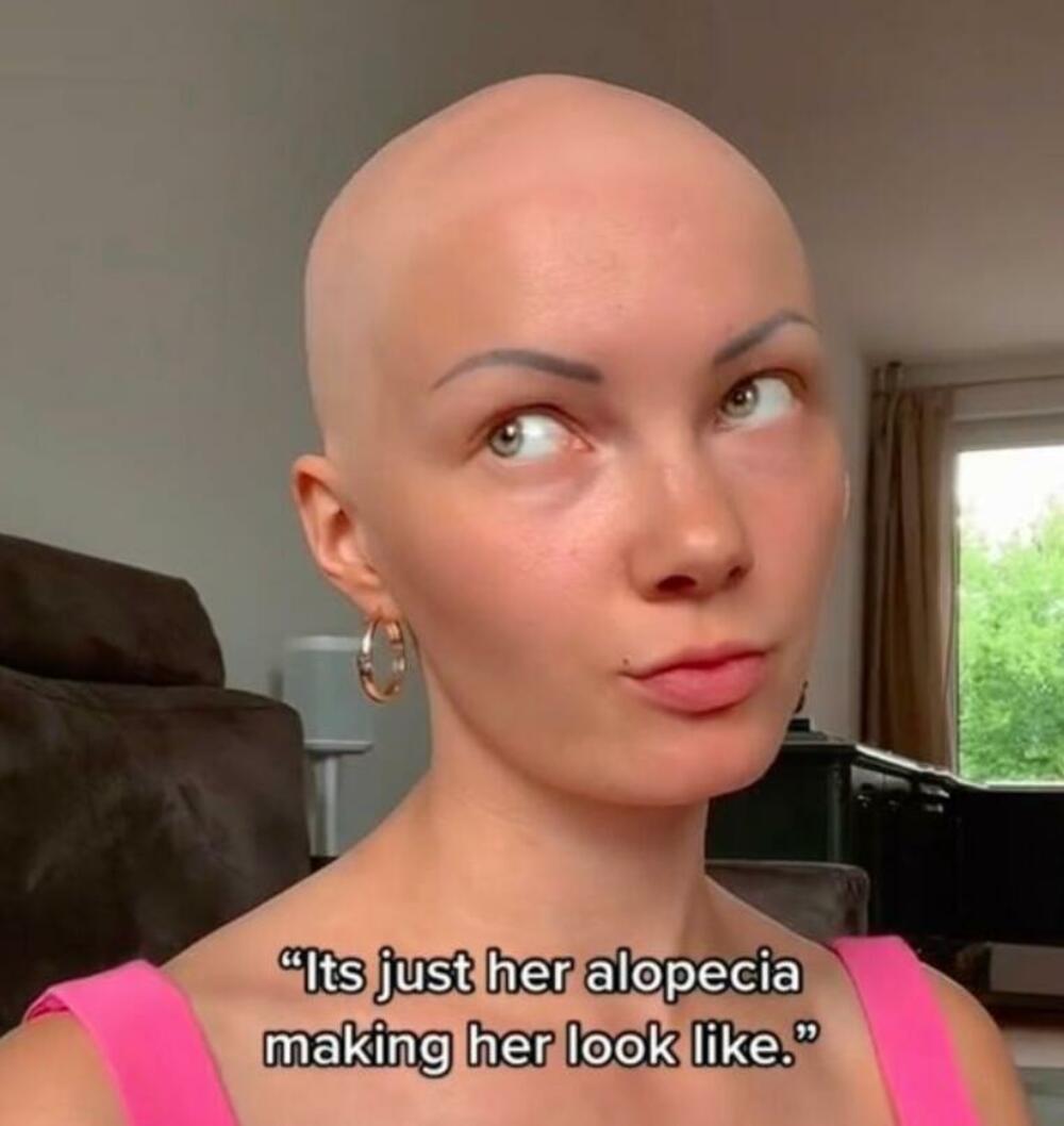 Alopecija