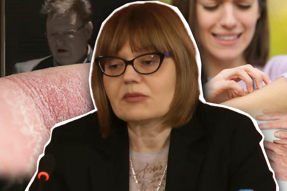 "ZA ŽIVOT BEZ PSORIJAZE": U Srbiji obolelo oko 140.000 ljudi od ove bolesti, biološka terapija je SPAS!