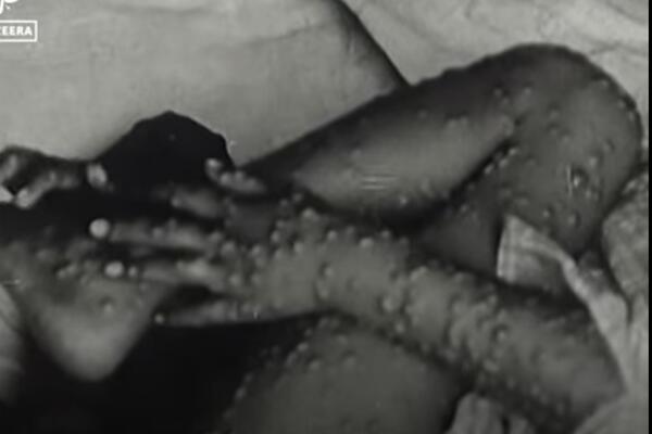 MASOVNA ZARAZA MAJMUNSKIH BOGINJA U NEMAČKOJ! Postoji 1 paralela kod OBOLELIH