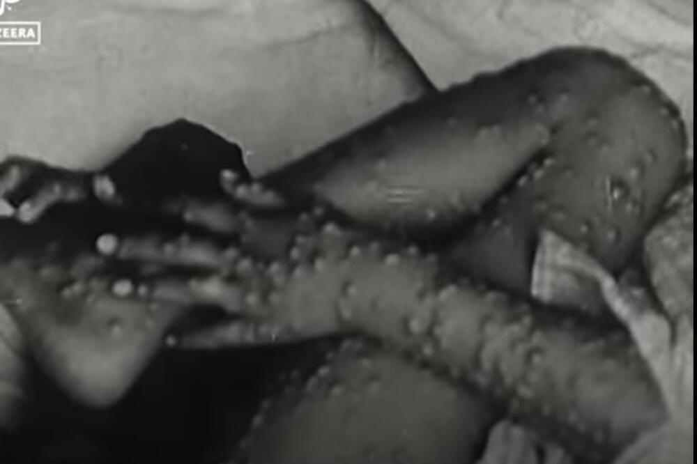 MASOVNA ZARAZA MAJMUNSKIH BOGINJA U NEMAČKOJ! Postoji 1 paralela kod OBOLELIH