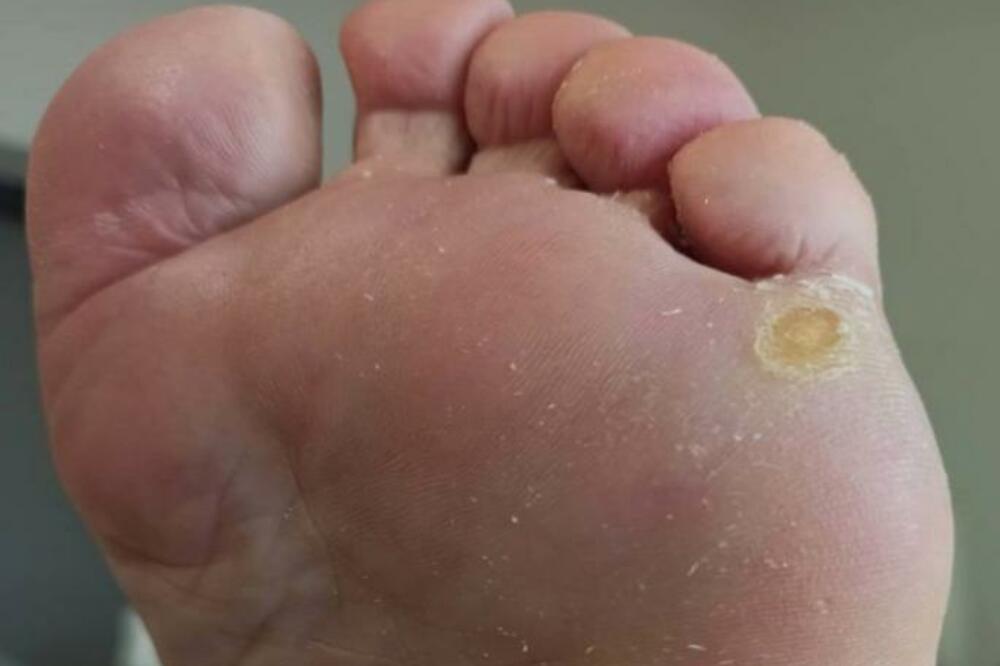 SVE SE VIDI NA STOPALIMA: Evo na koje BOLESTI UKAZUJE bol u peti, stalni žuljevi i opadanje dlaka - VODITE RAČUNA