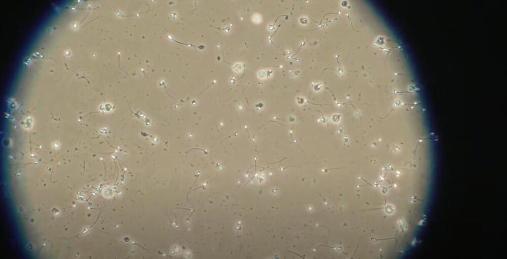 Urolog Milišević otkro zašto su loši spermatozoidi