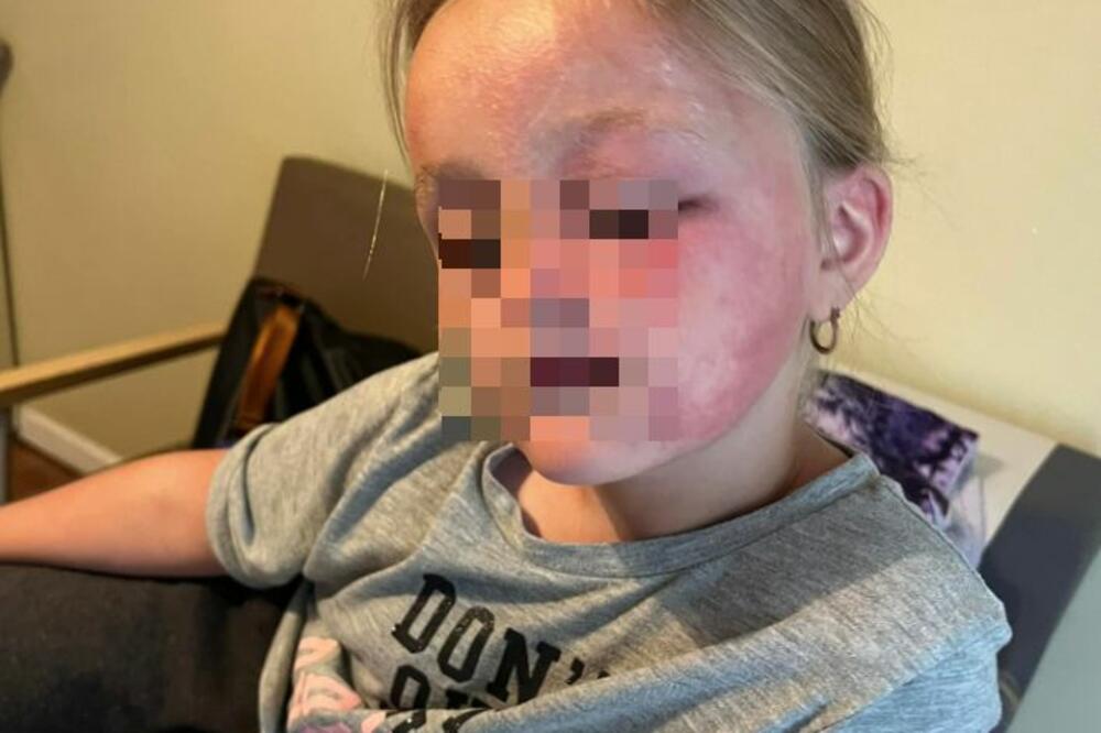 ŠESTOGODIŠNJAKINJA ZAVRŠILA U HITNOJ, A DISANJE JOJ JEDVA POVRATILI: A sve se činilo NAIVNO, kad ono HOROR!