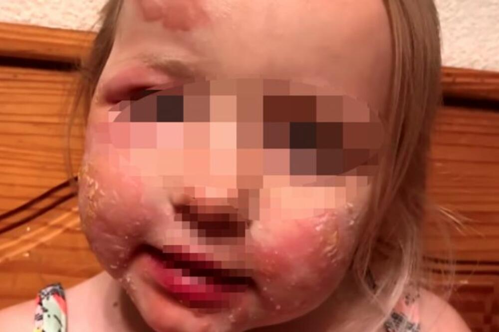 ČIM JE POJELA OVO VOĆE, DOBILA JE UŽASNE RANE PO LICU: Gore je od POŽARA, lekari upozorili sve