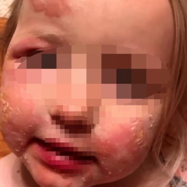 ČIM JE POJELA OVO VOĆE, DOBILA JE UŽASNE RANE PO LICU: Gore je od POŽARA, lekari upozorili sve