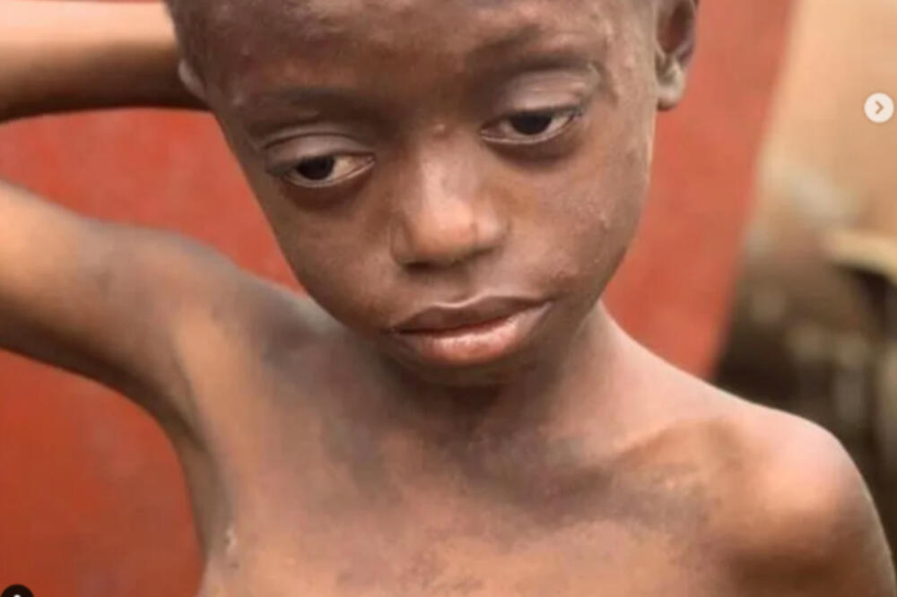 EVO KAKO SADA IZGLEDA DEČAK SA NAJPOTRESNIJE FOTKE: Pola života jeo otpatke i smeće, STRAVIČNI detalji (FOTO)