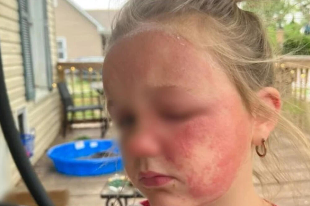 DEVOJČICA UMALO UMRLA ZBOG BILJKE KOJA RASTE U SRPSKIM DVORIŠTIMA: Unakazila ju je (FOTO)