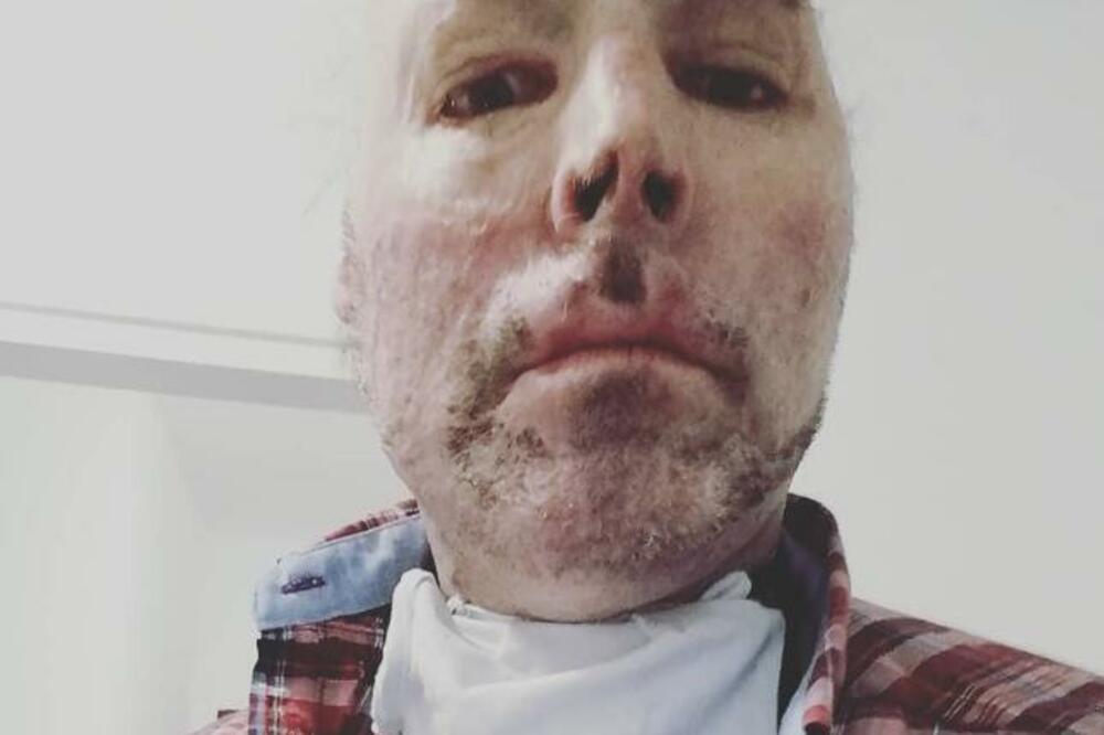 OVAJ ČOVEK JE OSTAO BEZ POLA GLAVE: Sada ga zovu pravim ČUDOVIŠTEM, evo kako IZGLEDA (FOTO)