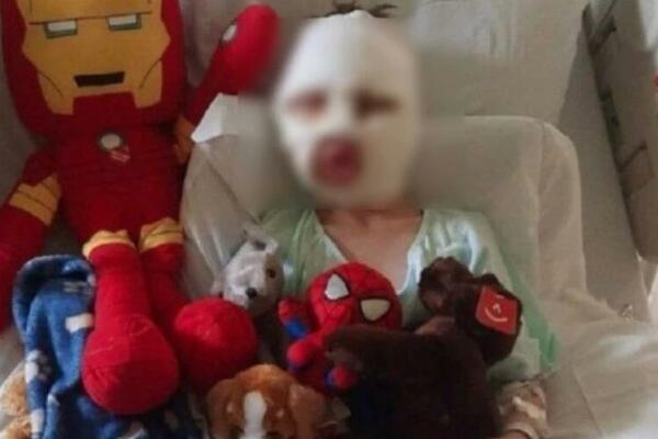 DEČAK(8) ZLOČINAČKI ZAPALIO DRUGARA (6) OVIM: Zbog neopreznosti roditelja, mališanu UNAKAŽENO lice, TUGA! (FOTO)