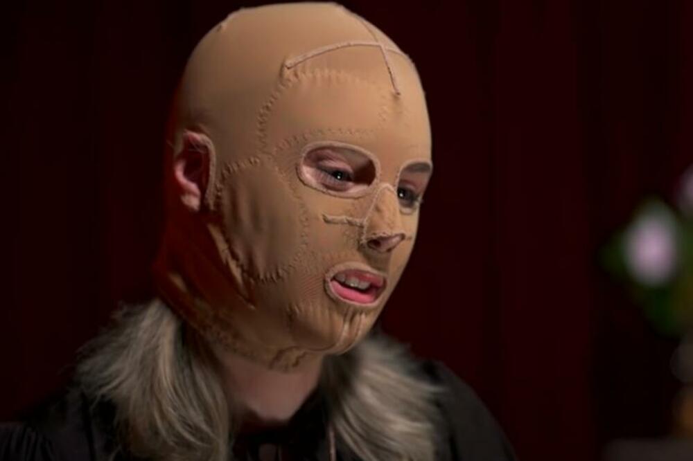 PREŽIVELA JE ERUPCIJU VULKANA, A NJENO LICE SADA IZGLEDA OVAKO: Isto je i sa 70 odsto TELA (VIDEO)