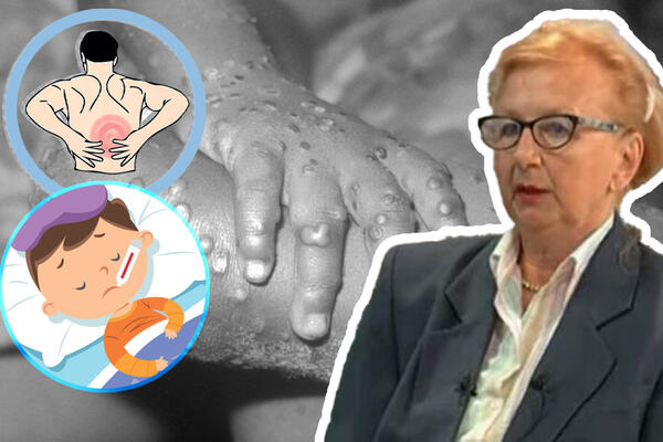 OVO SU SIMPTOMI MAJMUNSKIH BOGINJA KOJE SU STIGLE I DO NAS: Srpski virusolog otkriva!