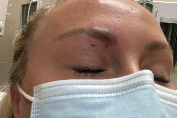 "OTVORILA SAM VRATA I SAMO ME JE ŠČEPALA"! Mara je doživela HOROR, ujed se vidi na njenom licu, UZNEMIRUJUĆE