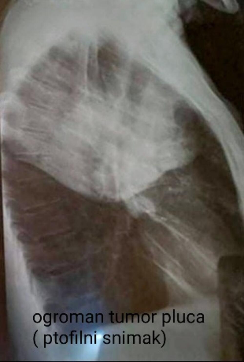 Profilni snimak ogromnog tumora